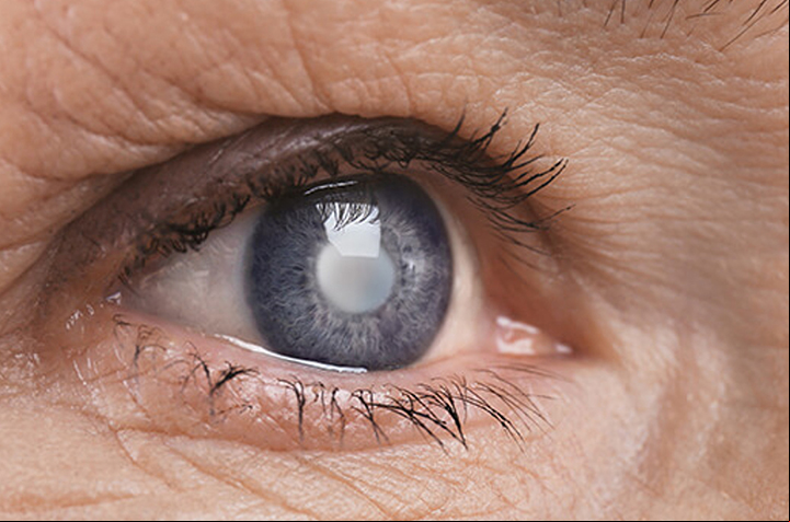 Cirurgia de catarata reduz efeitos do glaucoma que afeta 2,5 milhões