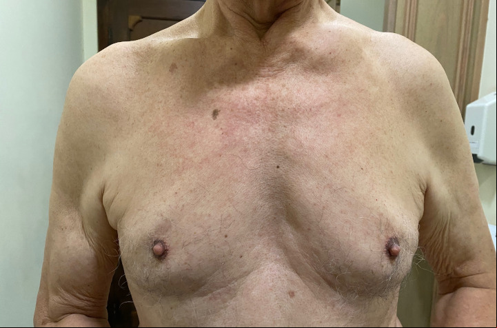 Câncer de mama em homens, veja os sintomas que merecem cuidados